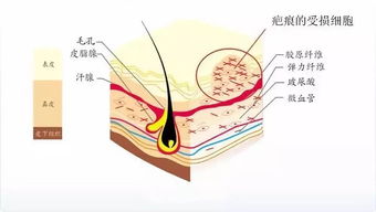 请接好 这是一盆泼自皮肤科医生的冷水 祛除疤痕 你需要的不是LAMER,而是