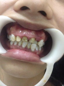 问 . 牙齿有点骨性龅牙,求问怎么弄牙齿能好看一点 
