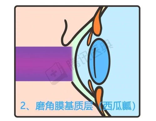 近视手术动的是眼睛哪个部位 会有后遗症吗
