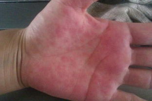 手部 湿疹 手部湿疹能自愈吗