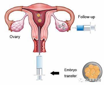 子宫内膜厚度与试管婴儿移植成功率有什么关系？