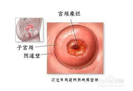 宫颈息肉手术多少钱 