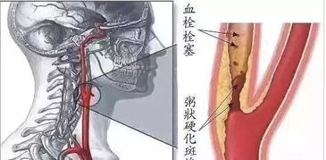 颈部气管被切断而不切颈动脉，是无法呼吸致死，还是组织液或血液进入肺部致死？