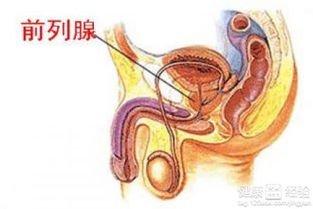 前列腺炎有四个缓解方法 预防发病要做到这七点