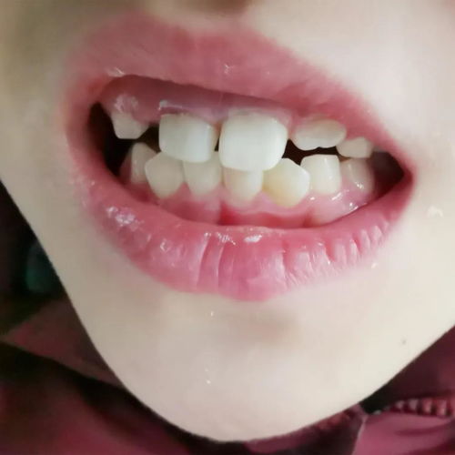 这家医院的儿童口腔急诊120真暖心 8岁女孩摔断门牙2两小时神奇长出 