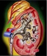 什么是髓质海绵肾