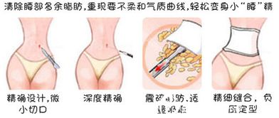 济南瑞丽s line匀称吸脂法,腰腹和大腿环脂都5280起