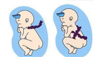 胎儿出现脐带绕颈,跟孕妇睡觉姿势有关吗 这里告诉你答案 