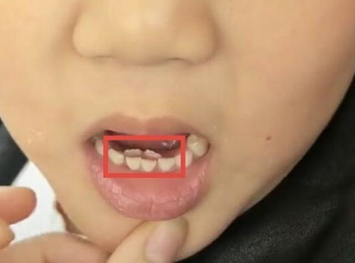 双排牙医生不建议拔掉牙(双排牙是拔里面还是外面)