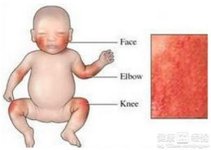 婴儿湿疹是怎么引起