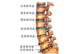 经常闪腰了怎么办 附 腰间盘突出预防闪腰攻略 