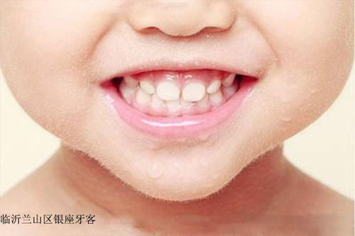 孩子五岁有轻微的蛀牙要去医院补牙吗