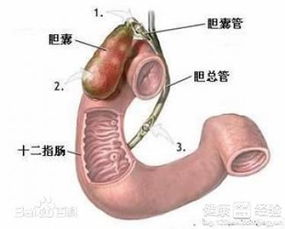 关于胆结石切除手术