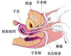 做无痛人流对身体的危害