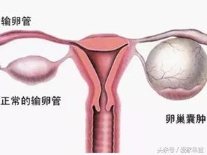 卵巢囊肿都没有恶变的可能 可能性有多大 