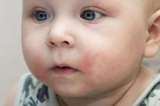 宝宝湿疹反复皮肤红肿,影响睡眠怎么办