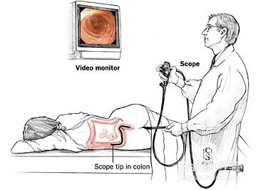 患者做肠镜检查需要注意哪些事项