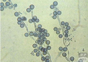 白色念珠菌感染 白色念珠菌感染的症状有哪些