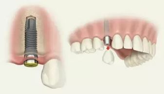 种植牙齿的利弊你都知道