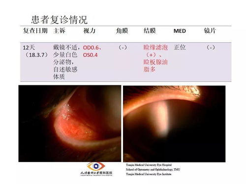 角膜塑形镜复查异常情况处理 病例汇报