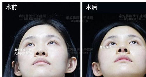22岁湖南姑娘,鼻头圆钝 鼻尖下垂,隆鼻45天后能变得多美