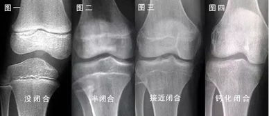 辉哥谈科学长高 骨骺线闭合还能长高吗 后天干预还能 窜一窜 