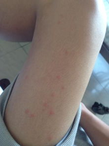 大腿外侧长好多个小红包,和蚊子叮的差不多,但不是蚊子叮的,很痒,有蔓延的倾向 