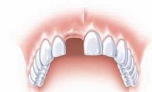 牙齿缺失了,可不是就掉一两颗这么简单 