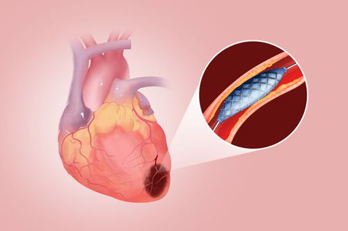 做心脏支架是利大，还是弊大(做心脏支架的好与坏)