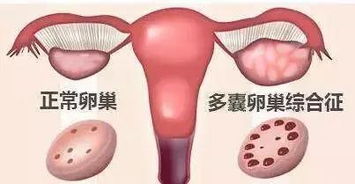 多囊卵巢综合征？多囊卵巢综合症是什么意思