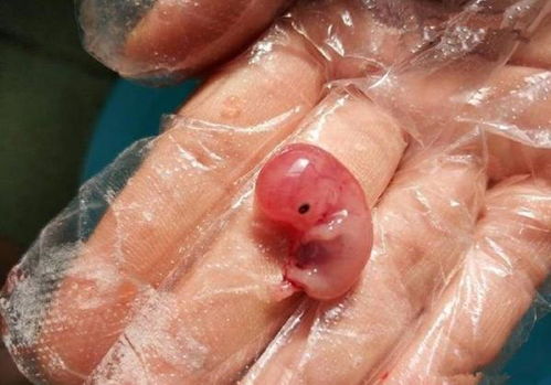 40天流产排出胚胎图片 