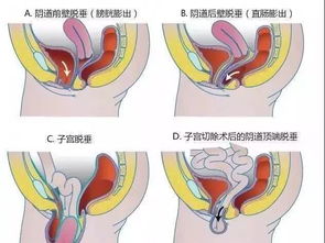 Ella自曝产后一打喷嚏就尿失禁 盆底肌损伤有多可怕 