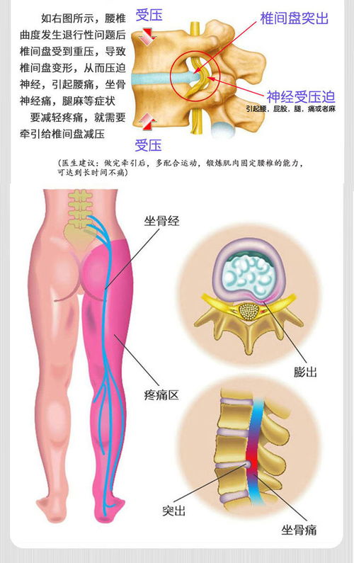 曲度腰椎间盘突出理疗仪腰肌劳损按摩器腰部疼痛颈多功能牵引理疗