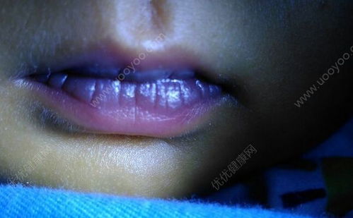 嘴唇发紫是怎么回事 嘴唇发紫是什么原因