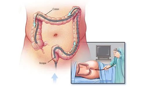 肠镜怎么做 痛苦吗 时间多久