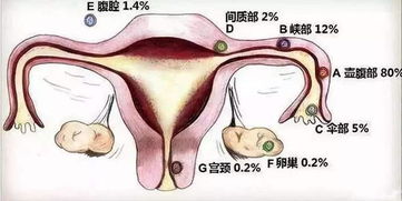 宫外孕四个诱因中,三个可能是男人引起的,情侣们一定要注意了