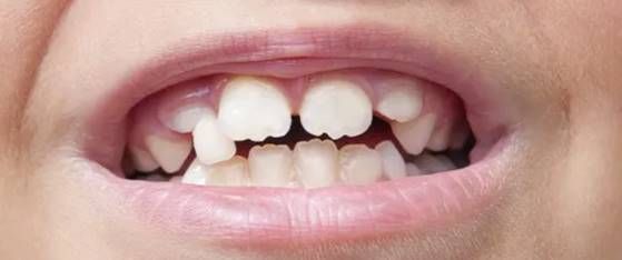 牙齿的健康需要优梨和大家的关注