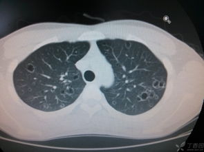 CT提示双肺囊腔,奇怪的病例 22岁青年男性咳嗽 胸痛