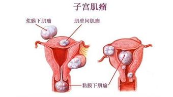 有子宫肌瘤可以吃毓婷吗