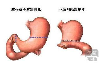 胃癌手术后病人吃什么好 饮食方面如何调整