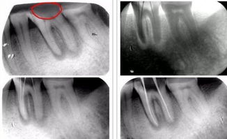为什么根管治疗要反复拍片
