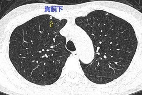 这个与血管相连的双肺多发小结节,是怎样的 神奇 疾病