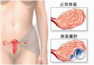 卵巢囊肿的最佳治疗方法是什么 