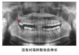 某明星拔完智齿,脸竟变成了这样 到底该不该拔 今... 政务 澎湃 ... 