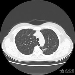 结核球 霉菌球及肺炎同时经典显现 请讨论学习