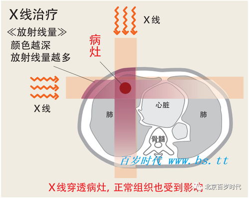 质子放射治疗是怎样作用于癌症 肿瘤 的 与传统放射治疗的差别