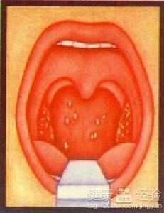咽白喉 咽白喉是什么病
