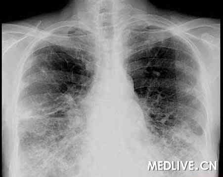 最新进展 肺纤维化或升高VTE风险 