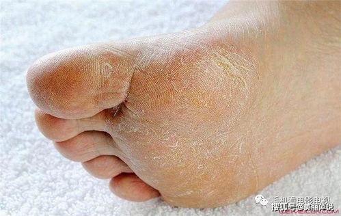 脚底脱皮痒是什么原因造成的 分析其中原因曝治疗方法