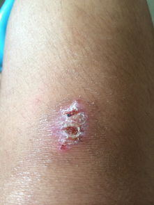 膝盖上的伤疤该怎么才会不留疤 